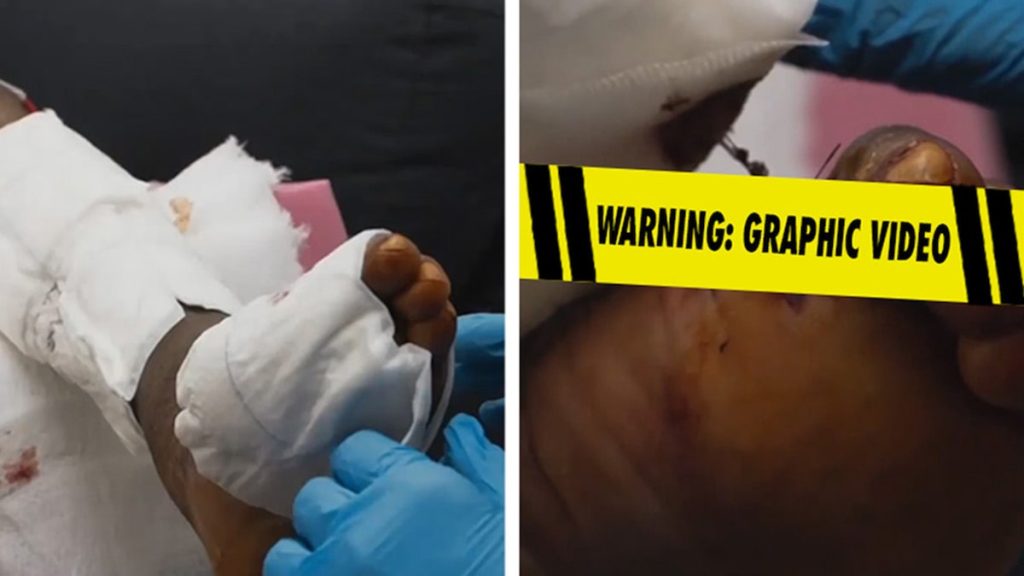 Deion Sanders' toe amputation revealed in new video