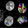 This shows brain scans in the perinatal period highlighting areas related to autism