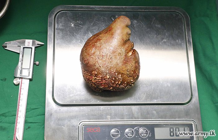 Large kidney stones on a scale.