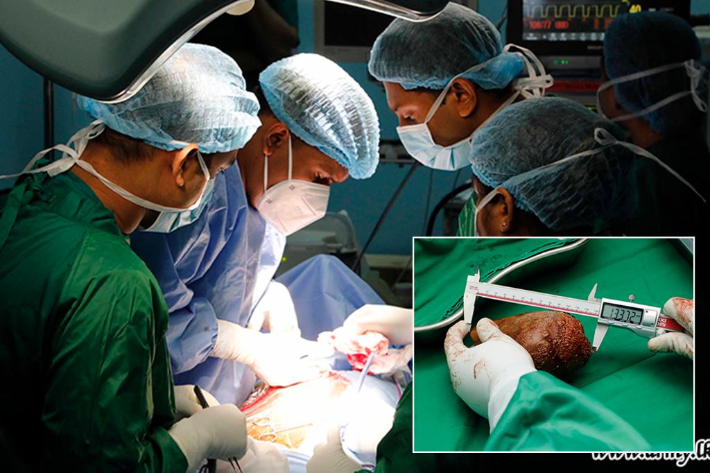 Doctors in Sri Lanka remove the "world's largest" kidney stone the size of a grapefruit